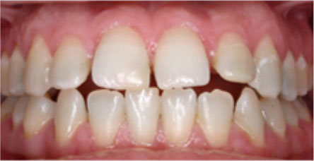 Invisalign Before and After Pictures Kinston, NC