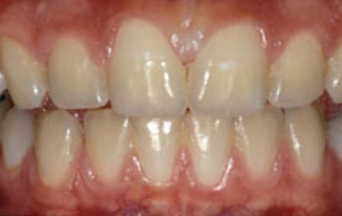 Teeth Whitening Before and After Pictures Kinston, NC