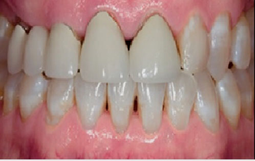 Dental Crowns Before and After Pictures Kinston, NC