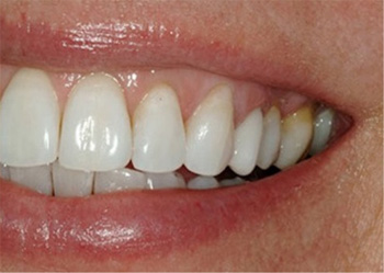 Dental Crowns Before and After Pictures Kinston, NC