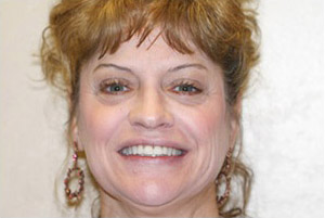 Invisalign Before and After Pictures Kinston, NC
