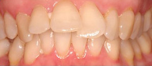 Invisalign Before and After Pictures Kinston, NC