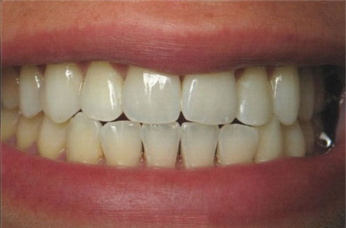 Teeth Whitening Before and After Pictures Kinston, NC