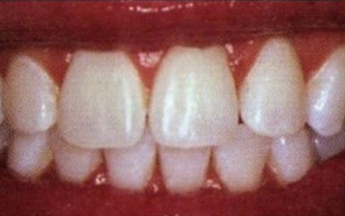 Teeth Whitening Before and After Pictures Kinston, NC